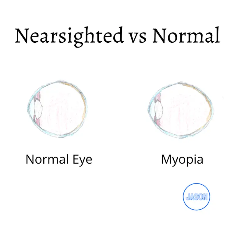 Is My Myopia Bad? A Table Summary
